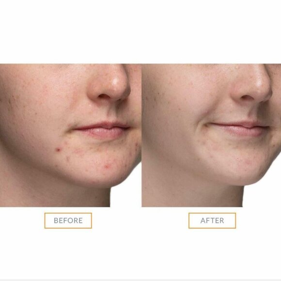 2 PACK Clarisonic Acne Cleansing Brush Head Replacements (2 EACH) NIB SEALED - Picture 7 of 13